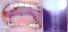 頸椎の歪みと歯の噛み合わせの関係
